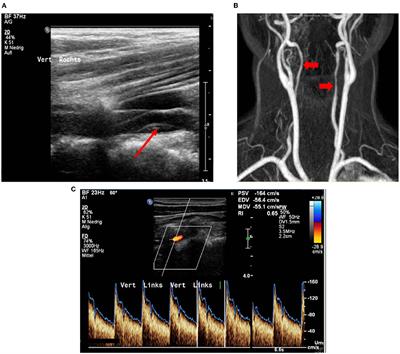 Long-Term Sonographical Follow-Up of Arterial Stenosis Due to Spontaneous Cervical Artery Dissection